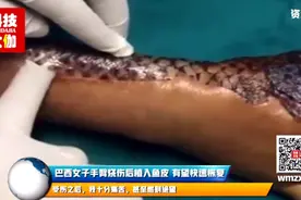 女子手臂烧伤后，科学家植入罗非鱼鱼皮，结果神奇恢复视频封面