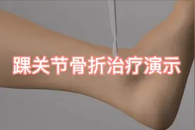 踝关节骨折治疗动画演示，看着都疼！视频封面