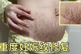 【产后日记】94年深圳宝妈重度妊娠纹第三次治疗修复全过程视频封面