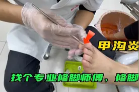 甲沟炎很困扰，王美丽找了个专业的师傅，修脚，指甲挖出瞬间解脱视频封面