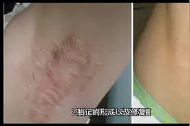 胎记的形成以及修复视频封面