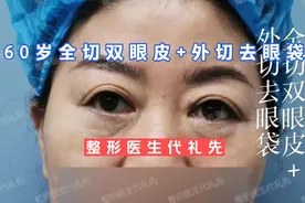 60岁女士全切双眼皮+外切去眼袋，女士说变化太大了。视频封面