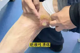 腿窝的挛缩疤痕曾经破了好了，这次咋就不愈合，建议手术，还要等视频封面