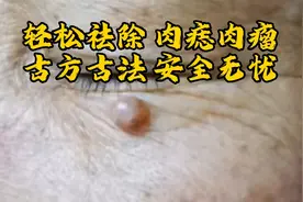 教你如何轻松祛除脸上的肉瘤肉痣视频封面