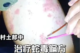 土郎中治疗蛇毒偏方，一般人都受不了视频封面