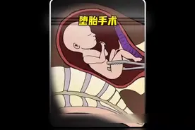 堕胎手术，女性必看。视频封面
