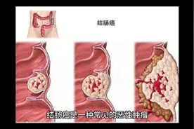 结肠癌中期生存期有多长？视频封面