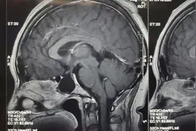 空蝶鞍该不该处理？应该如何处理？视频封面