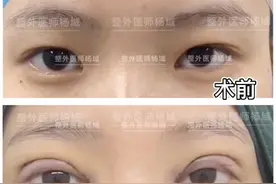 双眼皮案例分享图片
