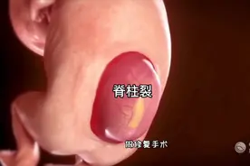 怀孕期间做胎儿脊柱裂手术过程，3D演示。。视频封面