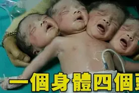 男孩一出生就有四個頭医生断言活不過一岁，他卻創造了奇跡连体人视频封面
