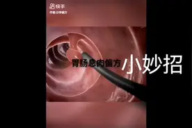 胃肠息肉小妙招：常喝苏打水视频封面
