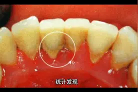 牙结石？太恶心！！！学学怎么办吧视频封面