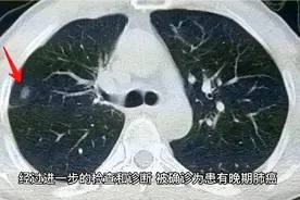 肺癌来临，睡觉先知？睡觉时有4个表现，当心是肺癌发出的信号视频封面