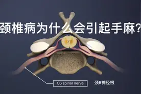 颈椎病为什么会引起手麻？动画演示