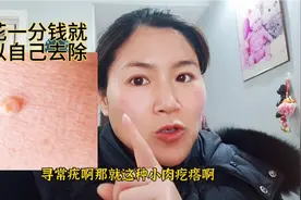 苏北媳妇亲测有效，无花果白色汁轻松去除各种疣，具体用法分享视频封面
