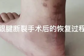 跟腱断裂手术后的恢复过程，60天基本可以正常行走了！视频封面