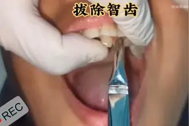 医生视角拔个牙，狠人狠操作视频封面