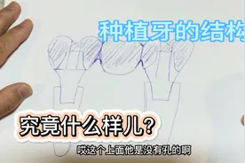 种植牙的结构究竟是什么样子的？视频封面