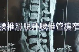 久坐起身腰痛，行走200米下肢酸困沉乏，医生说腰椎滑脱和椎管狭视频封面