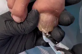 懒婆娘的脚趾甲啥样？费袜子费鞋的灰指甲，双脚真的对称啊！视频封面