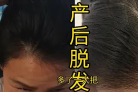 产后脱发，用茶麸浆和精油，头发猛涨，长得都不想要这么多头发了视频封面