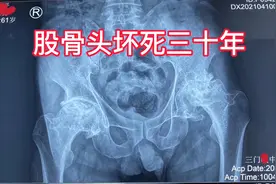 股骨头坏死三十年髋关节置换术后行正恢复正常视频封面