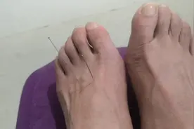 自己针灸脚三针，治疗长期失眠，偏头痛，血压高。视频封面