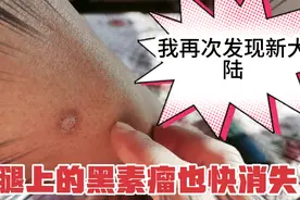 我发现新大陆，腿上的黑素瘤快没有了，对青春期孩子长痘痘也管事视频封面
