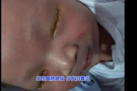 婴儿流眼泪眼屎多流黄色液体且黏稠视频封面