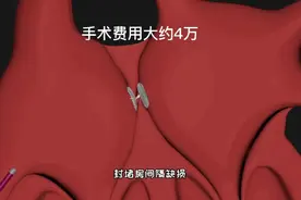 这才是手术，心脏房间隔缺损封堵手术过程，3D演示。。视频封面