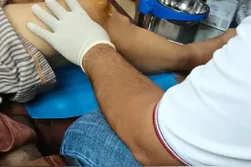 专业治疗溶解痛风石（尿酸红精）视频封面