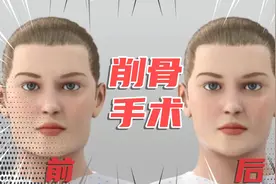方脸“削骨手术”怎么做，揭秘杨幂的脸（下巴）是怎么变小的？视频封面