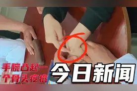 手腕凸起一个骨头疙瘩,诊断是腱鞘囊肿，手法治疗视频封面