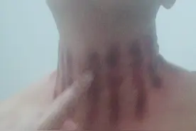今天不舒服又揪痧了视频封面