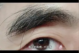 眉毛脱落—大风痛视频封面