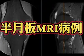 动态MRI图像上如何看半月板撕裂？典型病例分享！视频封面