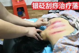 银砭刮痧治疗落枕视频封面