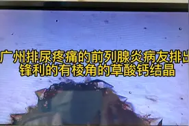 广州排尿疼痛的前列腺炎病友排出锋利的有棱角的草酸钙结晶视频封面