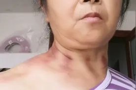 中暑自己揪痧，绿色疗法真好，不须吃药，打针，揪好一身轻松。视频封面
