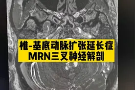 【典型表现】椎基底动脉扩张延长症，三叉神经，脑干压迫核磁表现视频封面