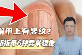 为什么指甲上有竖纹？帮你了解关于指甲的6种常见现象！视频封面