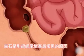 急性阑尾炎微创手术科普演示！视频封面