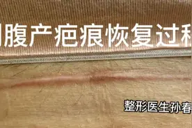剖腹产术后疤痕增生，给予修复治疗，大家看一下半年后效果。视频封面