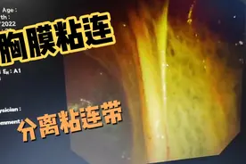 胸腔镜：胸膜腔大量粘连带，看完你就明白为什么抽不到胸水了！视频封面