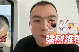 植发43天了，植发的后遗症出现了很多问题视频封面