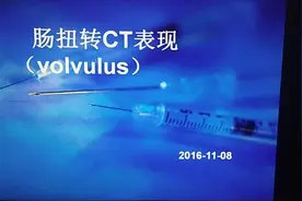 老年男性，胃切除术后腹痛，恶心，呕吐就诊，诊断为肠扭转。视频封面