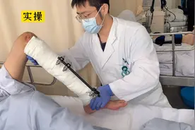 小王的掰腿日常（胫腓骨下段骨折术后一个月）视频封面