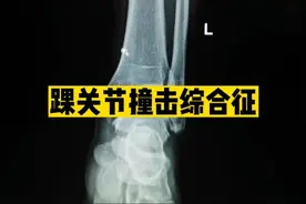 30岁，运动后反复足痛，足跟痛，踝关节撞击综合征X线表现！视频封面