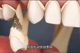 牙齿松动会自愈吗？视频封面